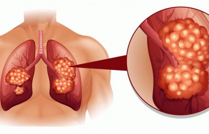 أمراض
      الجهاز
      التنفسي
      وطرق
      الوقاية
      منها