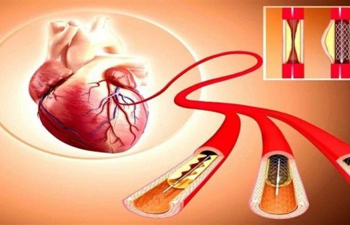 روسيا..
      تطوير
      تقنية
      الطباعة
      ثلاثية
      الأبعاد
      للدعامات
      المستخدمة
      في
      علاج
      أمراض
      القلب
      التاجية