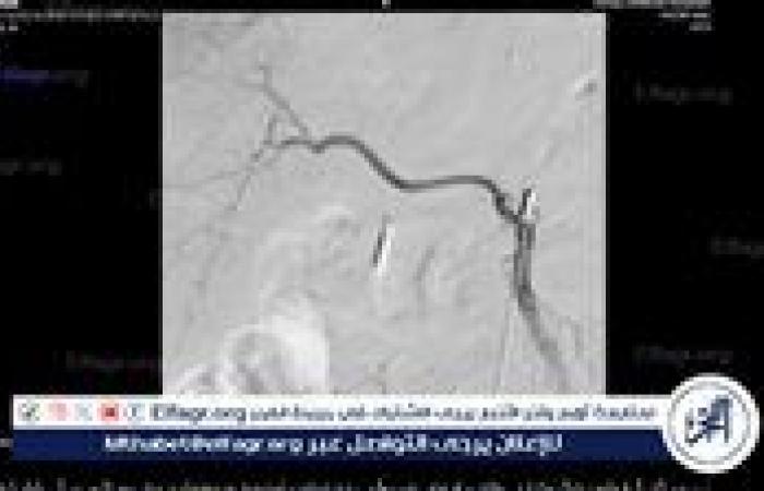 نجح
      فريق
      طبى
      بمستشفى
      سوهاج
      الجامعى
      بإيقاف
      نزيف
      حاد
      لمسن
      75
      عاما