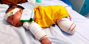 الرضيع محمد الخطيب فقد أمه وبترت قدمه فى الحرب وينتظر فرصة العلاج خارج غزة