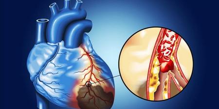 نتائج صادمة حول تأثير الحي السكني على الشرايين والقلب