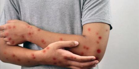 باحثون يحددون أجسامًا مضادة قد تمنع وتعالج عدوى الحصبة