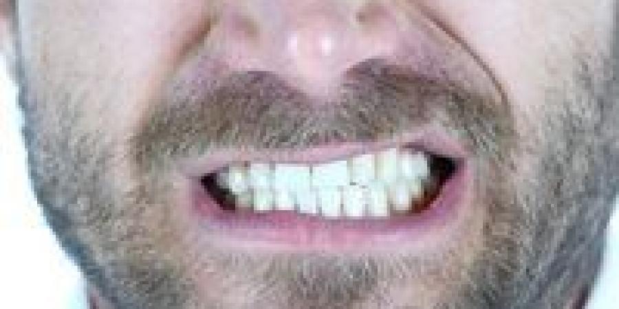 كارثة
      تبييض
      الأسنان..
      منتجات
      "قاتلة"
      تباع
      عبر
      الإنترنت
      تهدد
      بابتسامة
      مدمّرة