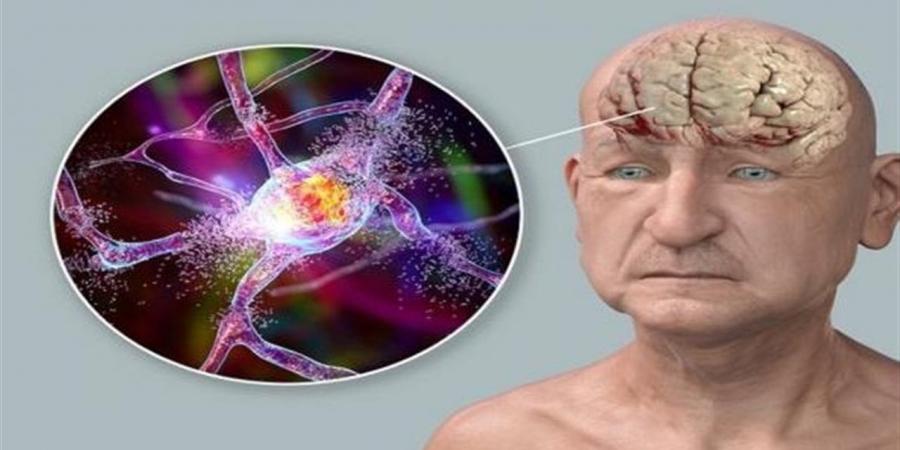 اكتشاف
      مؤشر
      بيولوجي
      لتسارع
      شيخوخة
      الدماغ