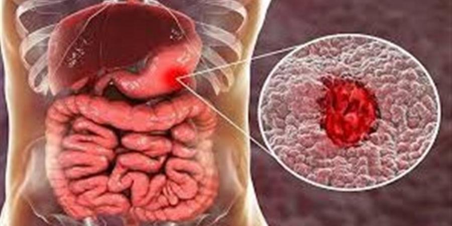 من الطعام إلى التوتر.. أسباب متعددة وراء القولون العصبي
