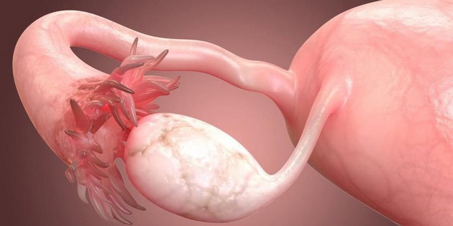 عقار لمرض نادر يطيل عمر مريضات أخطر أنواع سرطان المبيض