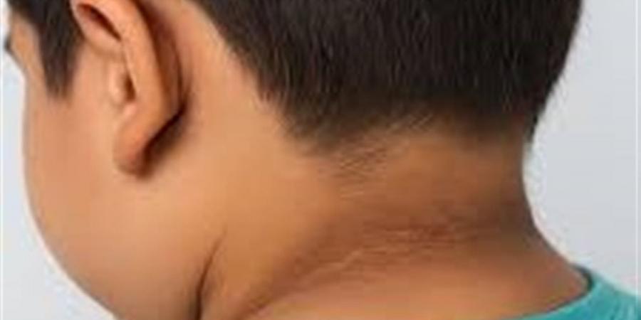 اسمرار الرقبة وتحت الإبط عند الأطفال: علامة صحية لا يجب تجاهلها