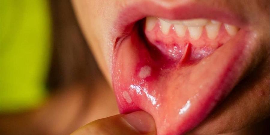 ما تأثير التهابات الفم على القلب؟