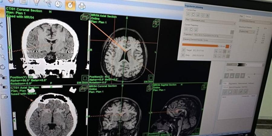 تقنية جديدة لعلاج الصرع في مستشفيات دمياط الحكومية