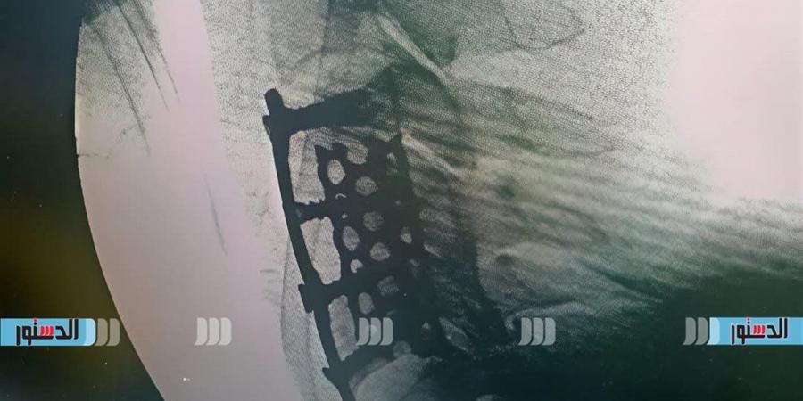 إنقاذ مريض من شلل رباعي.. نجاح جراحة دقيقة بكفر الشيخ في أخطر حالات العمود الفقري العنقي